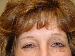 Botox injections - after - worcester ma