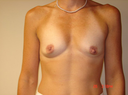 breast augmentation - breast enhancement - before - worcester ma -cosmetic and plastic surgery