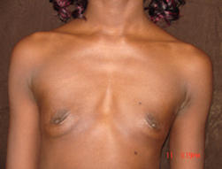breast augmentation before