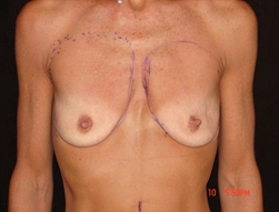 breast augmentation before photo